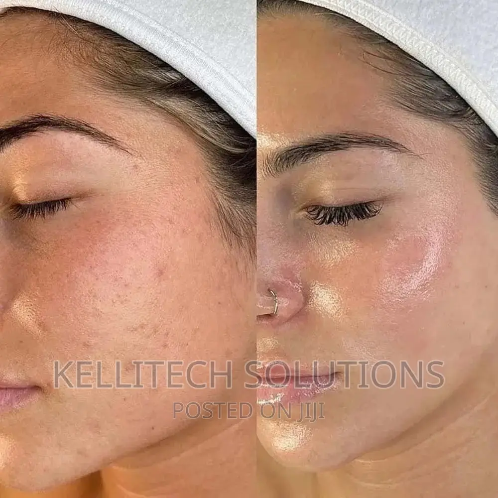 Derma Roller (0.5mm, 540needles) Promo
