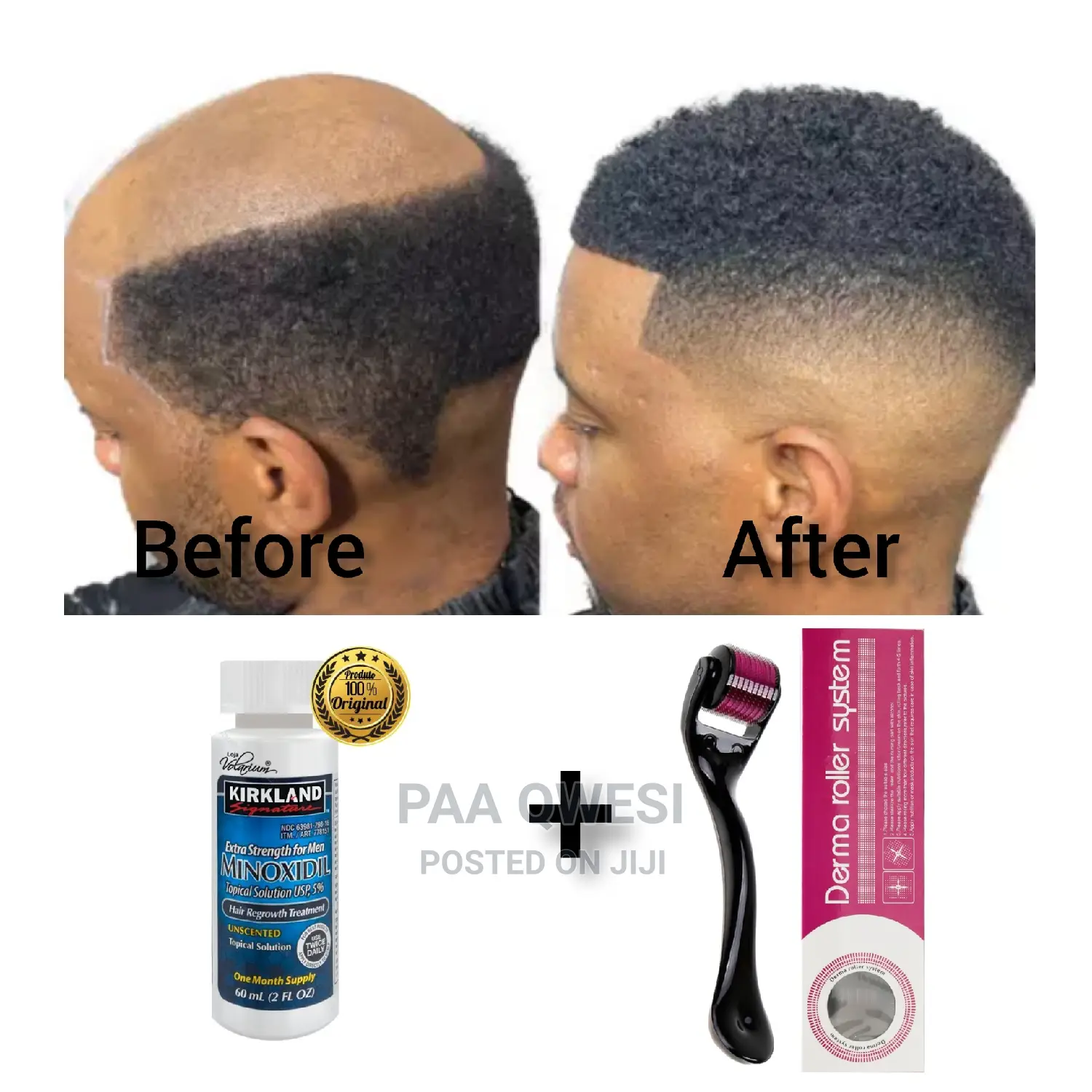 Derma Roller System Kirkland Undiluted Oil