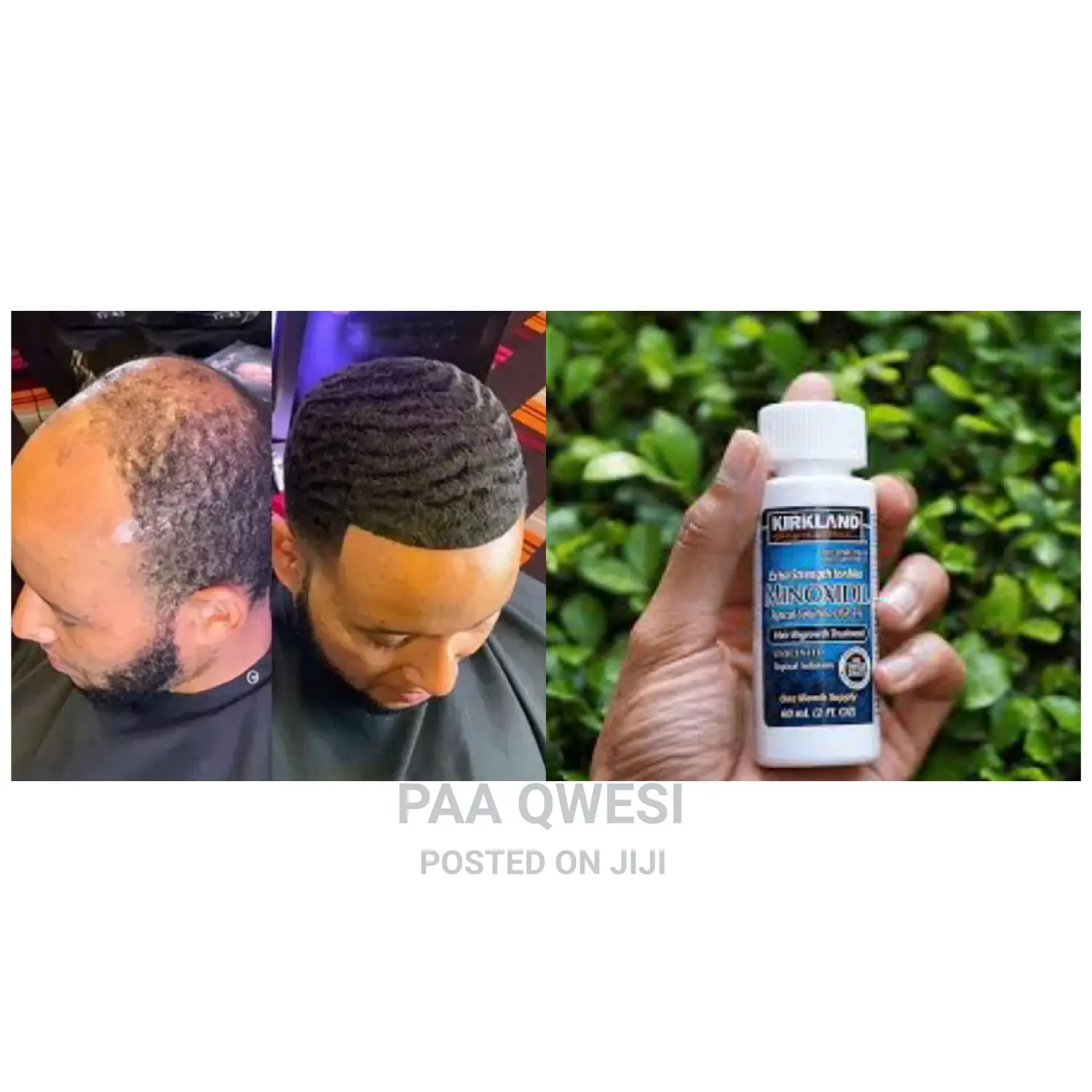 Kirkland Minoxidil Hair Growth Treatment