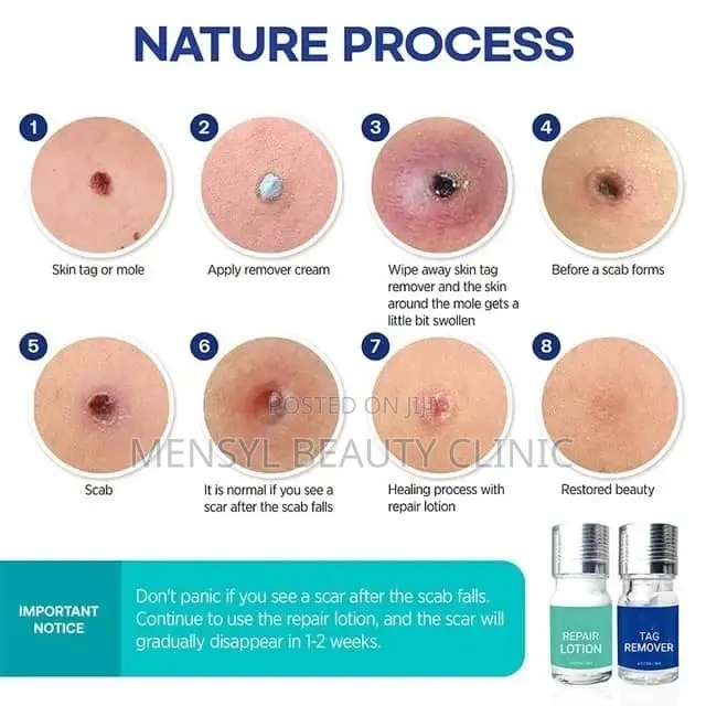 Medical Grade Skin Tag, Genital Wart and Mole Removal 2 in 1