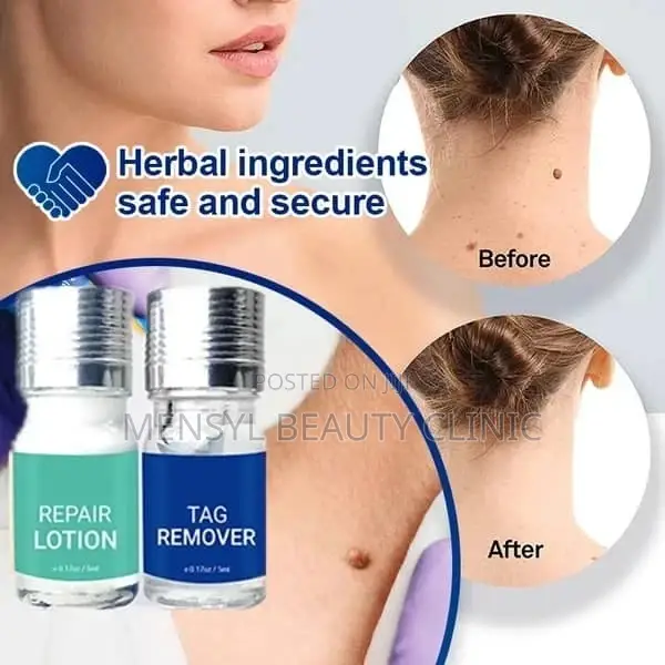 Medical Grade Skin Tag, Genital Wart and Mole Removal 2 in 1