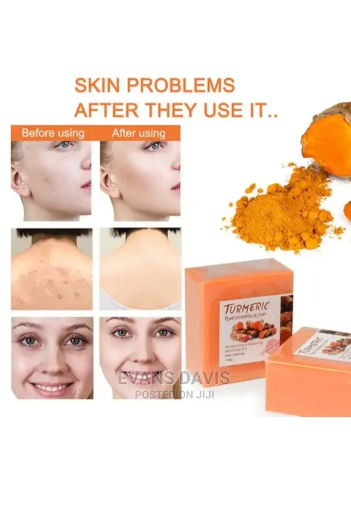 Tumeric Acne, Sunburns and Dark Spot Remover Soap