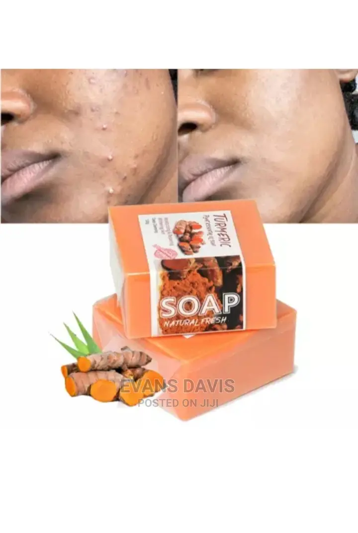 Tumeric Acne, Sunburns and Dark Spot Remover Soap