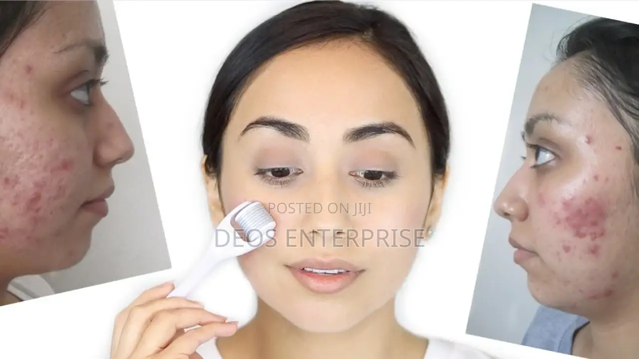 Derma Roller for Treating Scalps