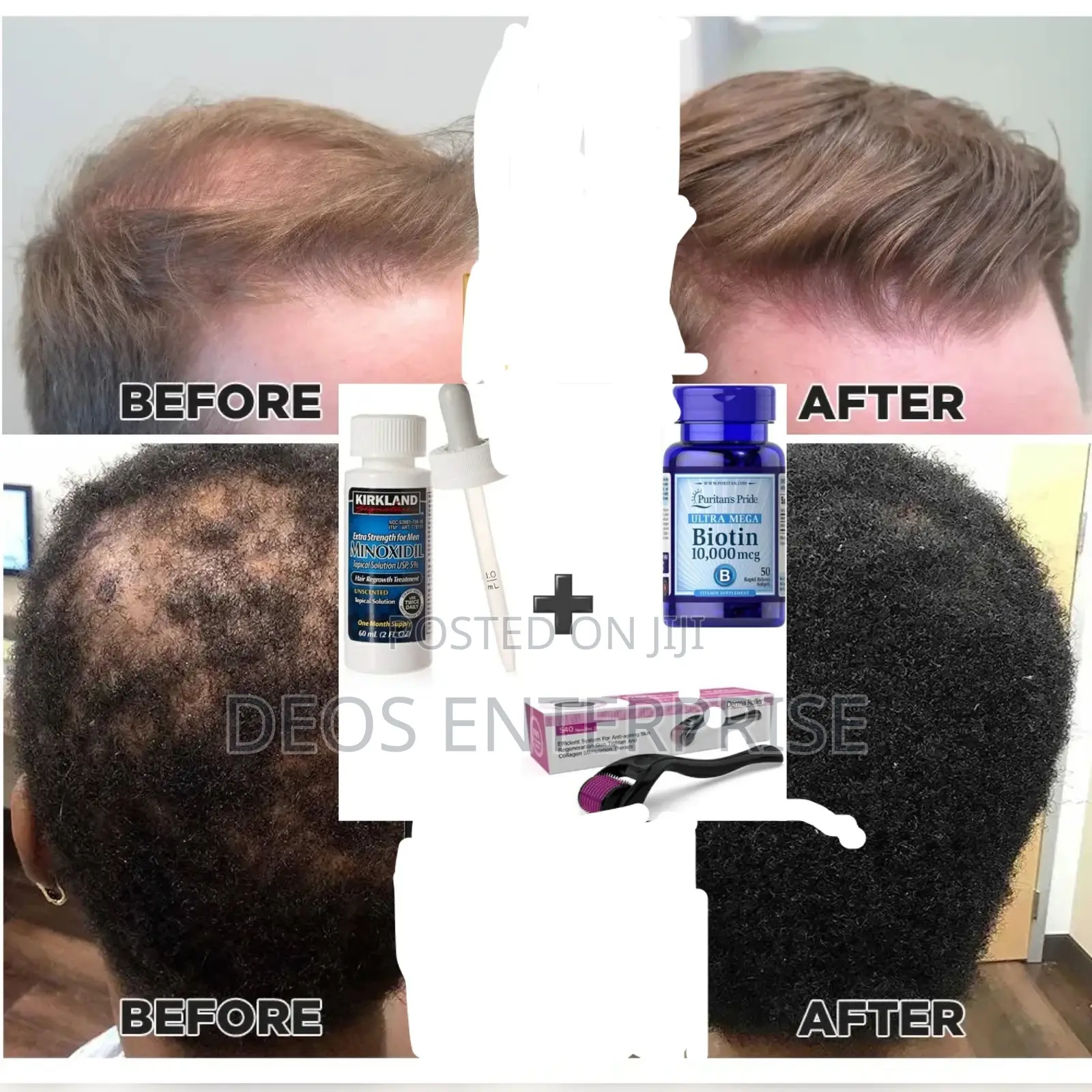 Recommended Super Combo for Beard and Hair Growth