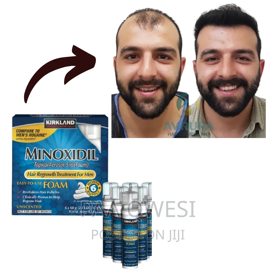 Kirkland Foam ( Hair Regrowth Treatment for Men