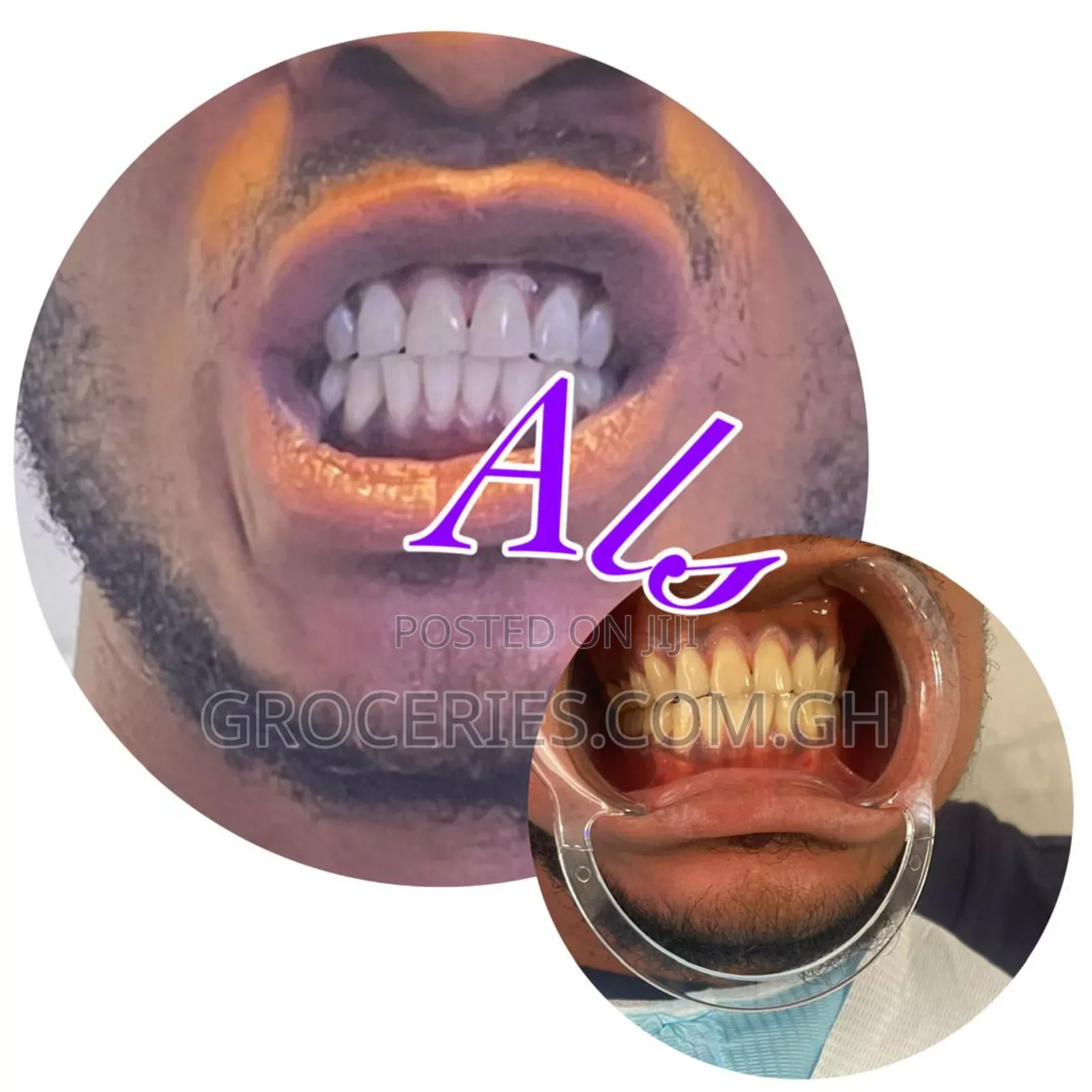 Laser Teeth Whitening