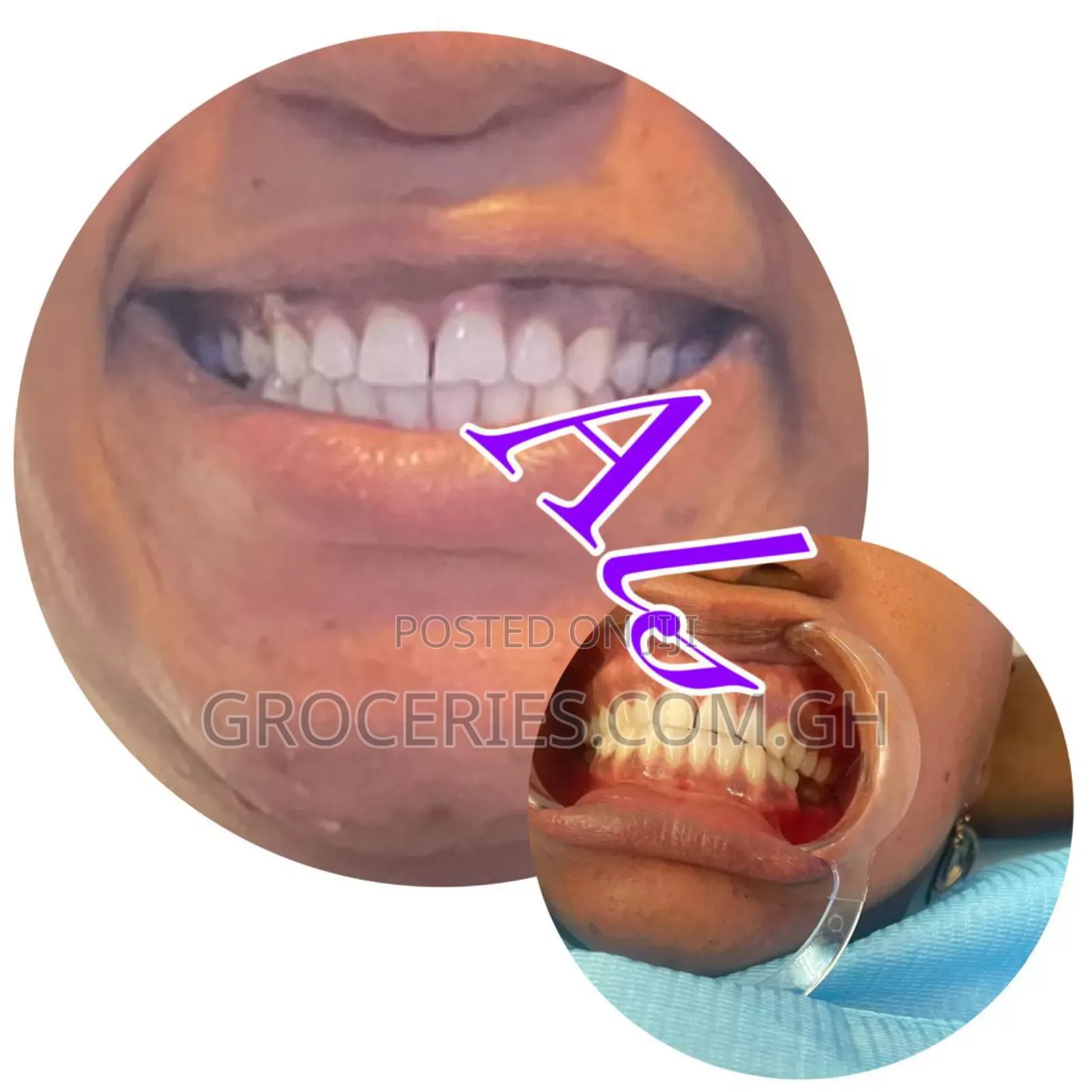 Laser Teeth Whitening