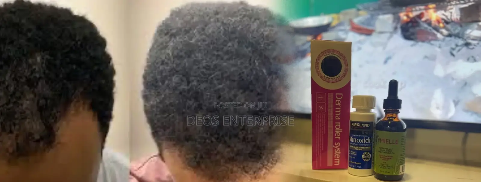 Kirkland Minoxidil Mielle Roller for Hair Baldness