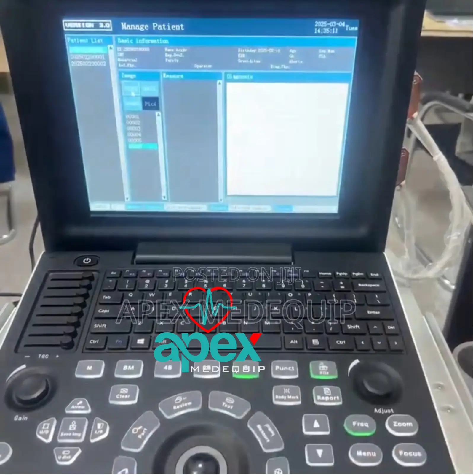 Portable Digital Ultrasound Sonotec Dp30 + 1 Probe + Trolley
