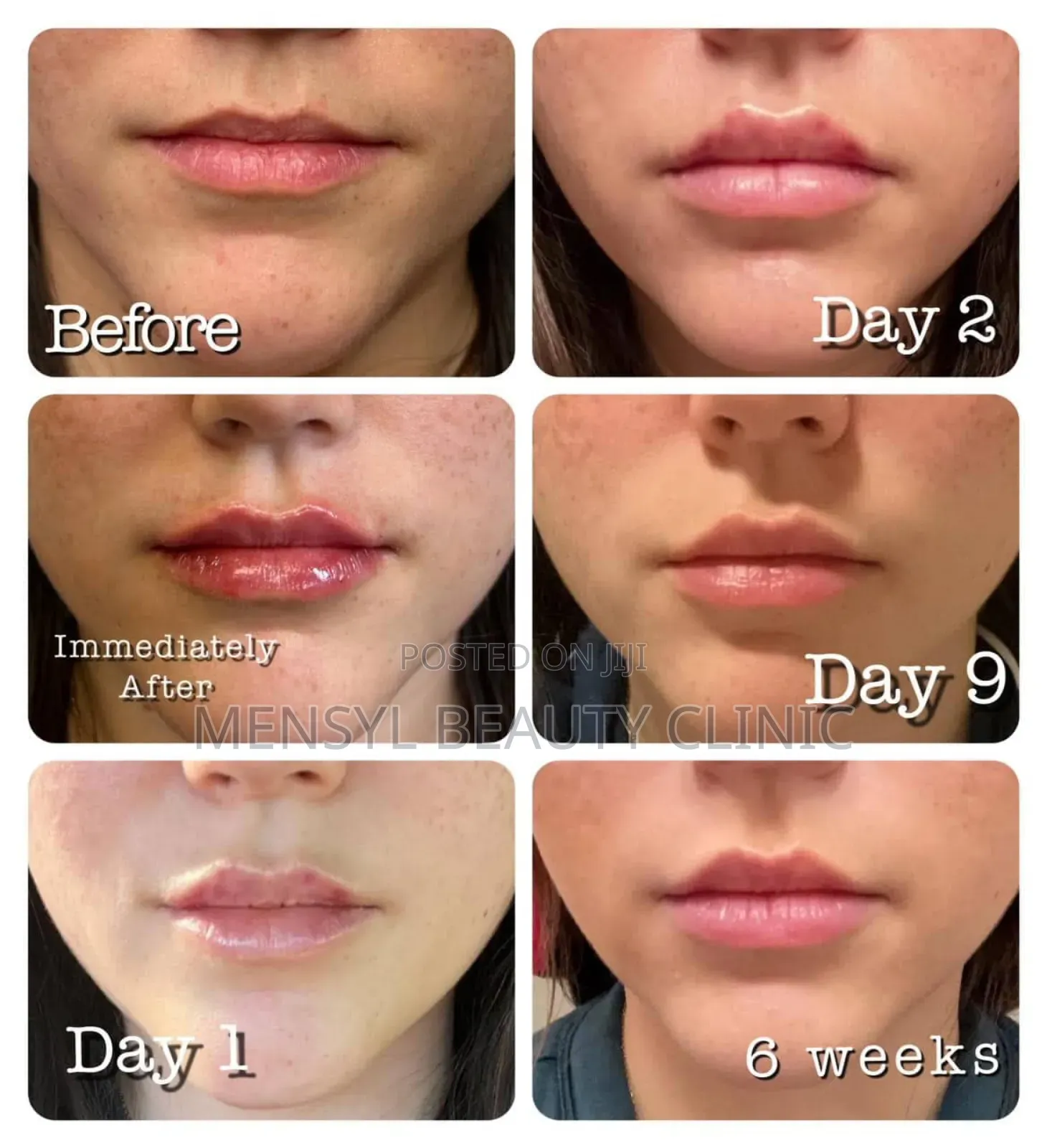 Bellast Ha Facial Filler Is Korean Dermal Fillers for Face