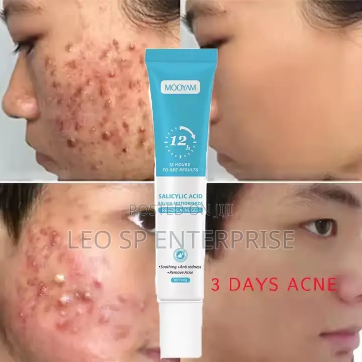 Pimples and Acne Cream