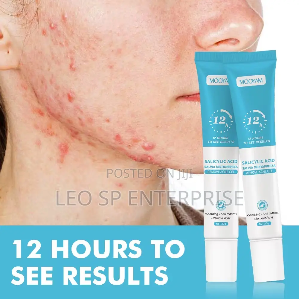 Pimples and Acne Cream