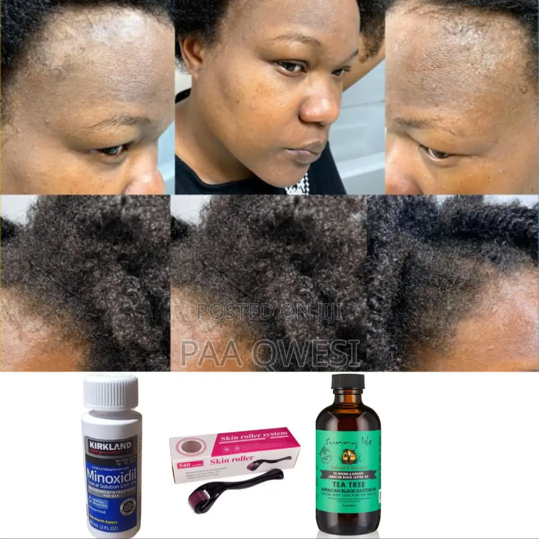 Effective Hair Growth- Use Sunny Isle Tea Tree W/Minoxidil