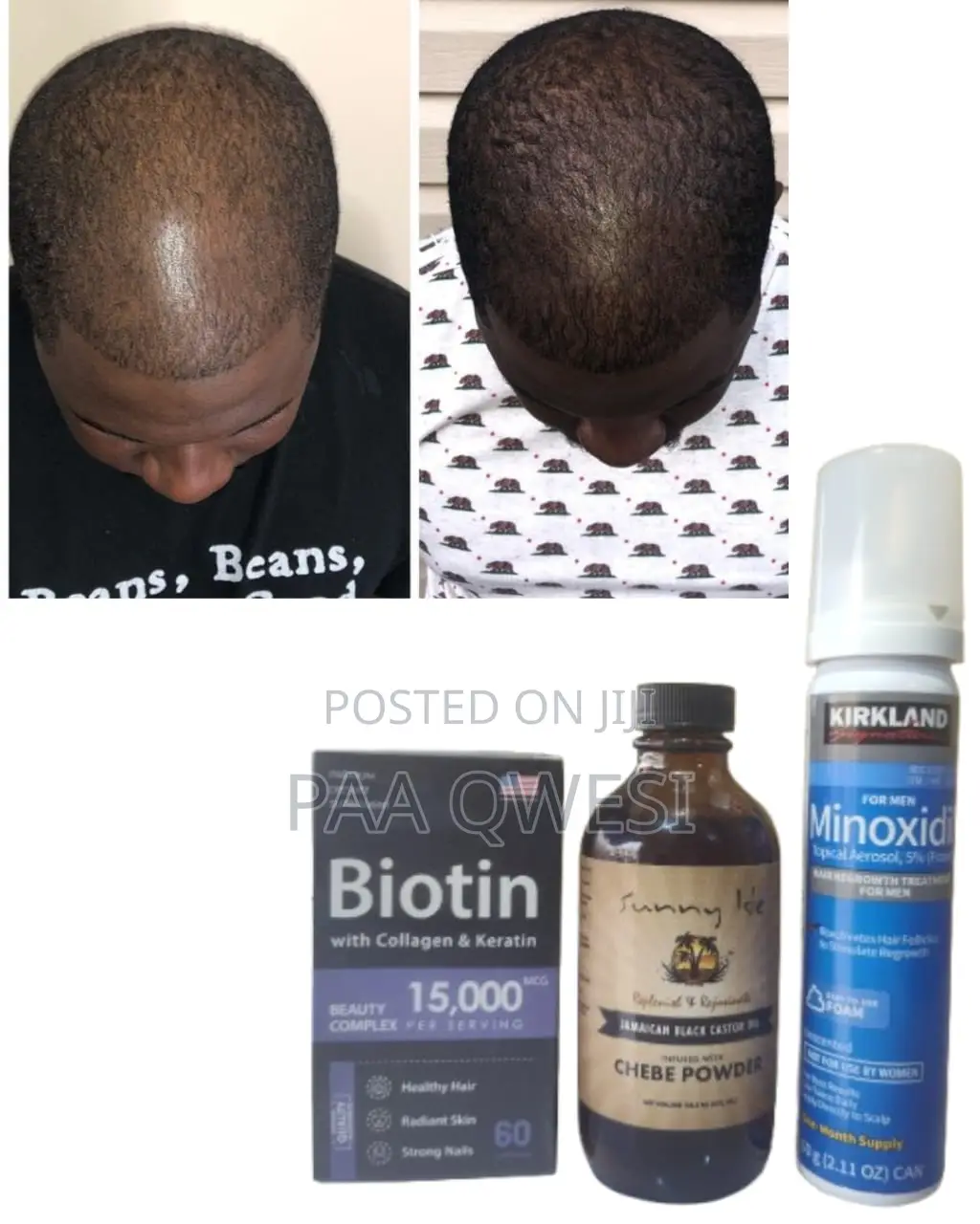 Biotin + Kirkland Foam+ Chebe Powder Oil Hair Growth Combo