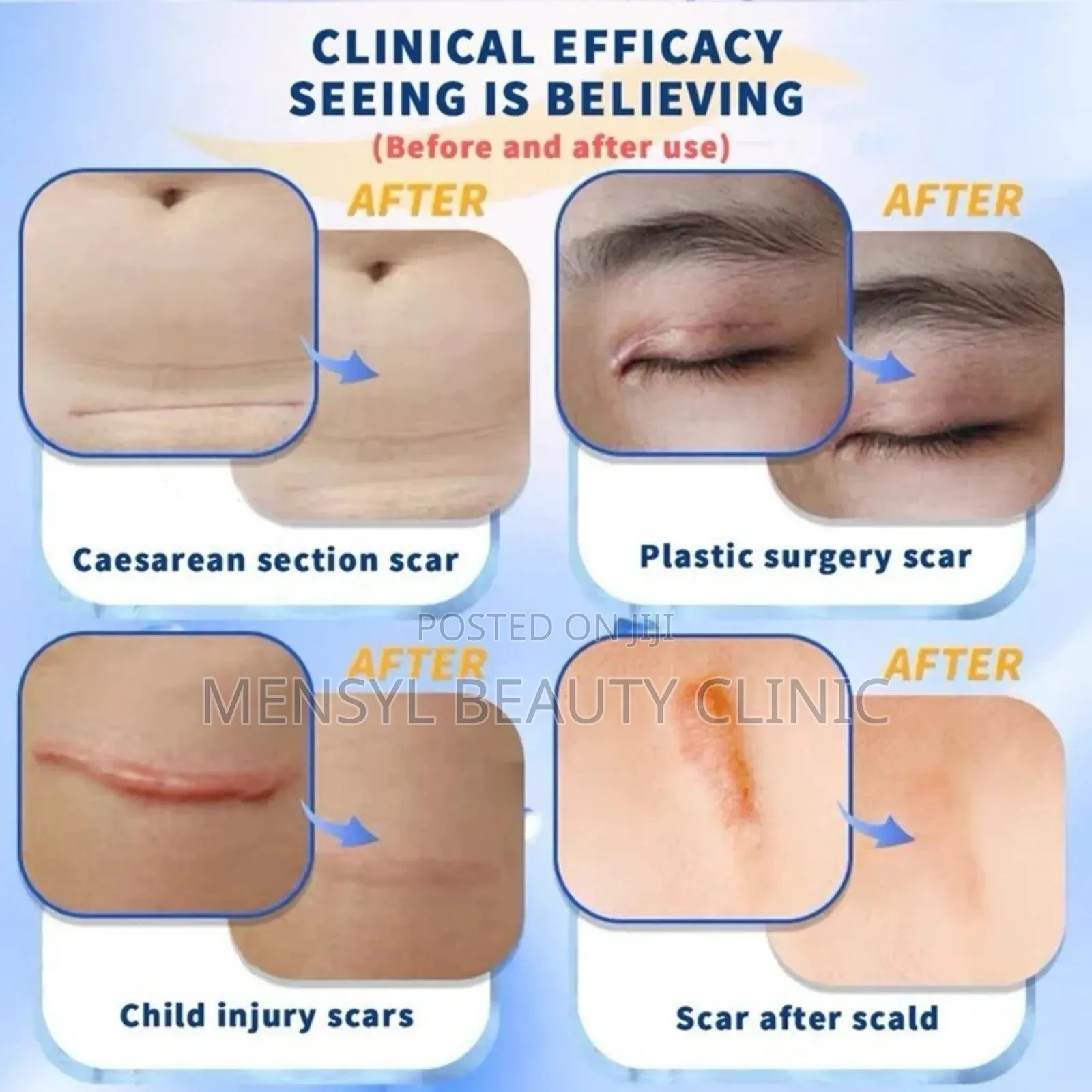 Dermatix Ultra Advanced Scar Gel Cutsburns,C-Section Keloid