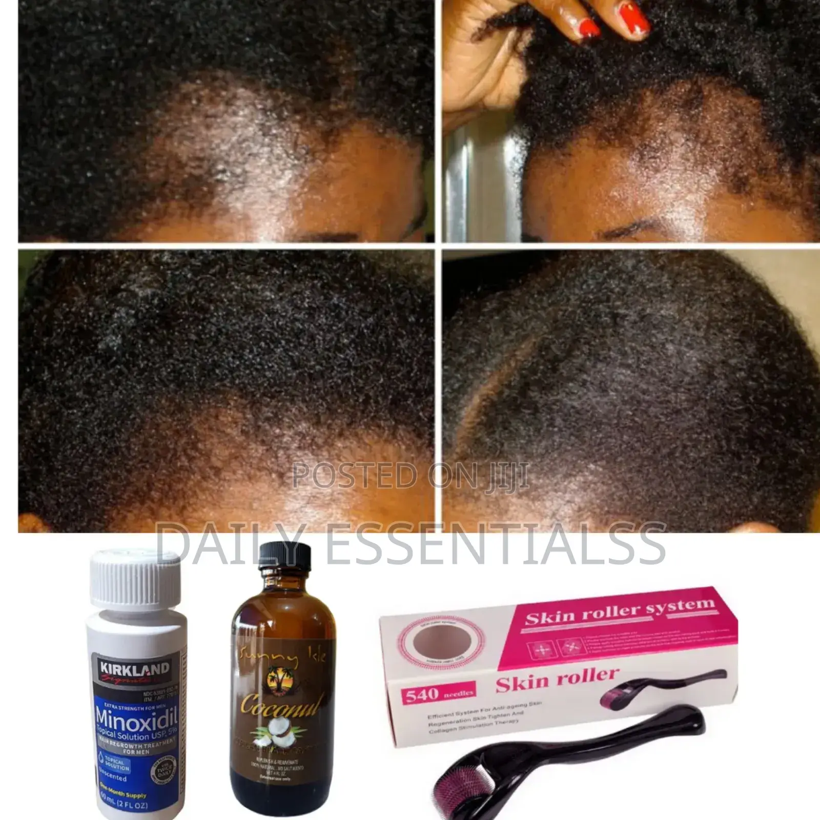 Kirkland , Coconut Oil + Derma Roller for Hair Regrowth