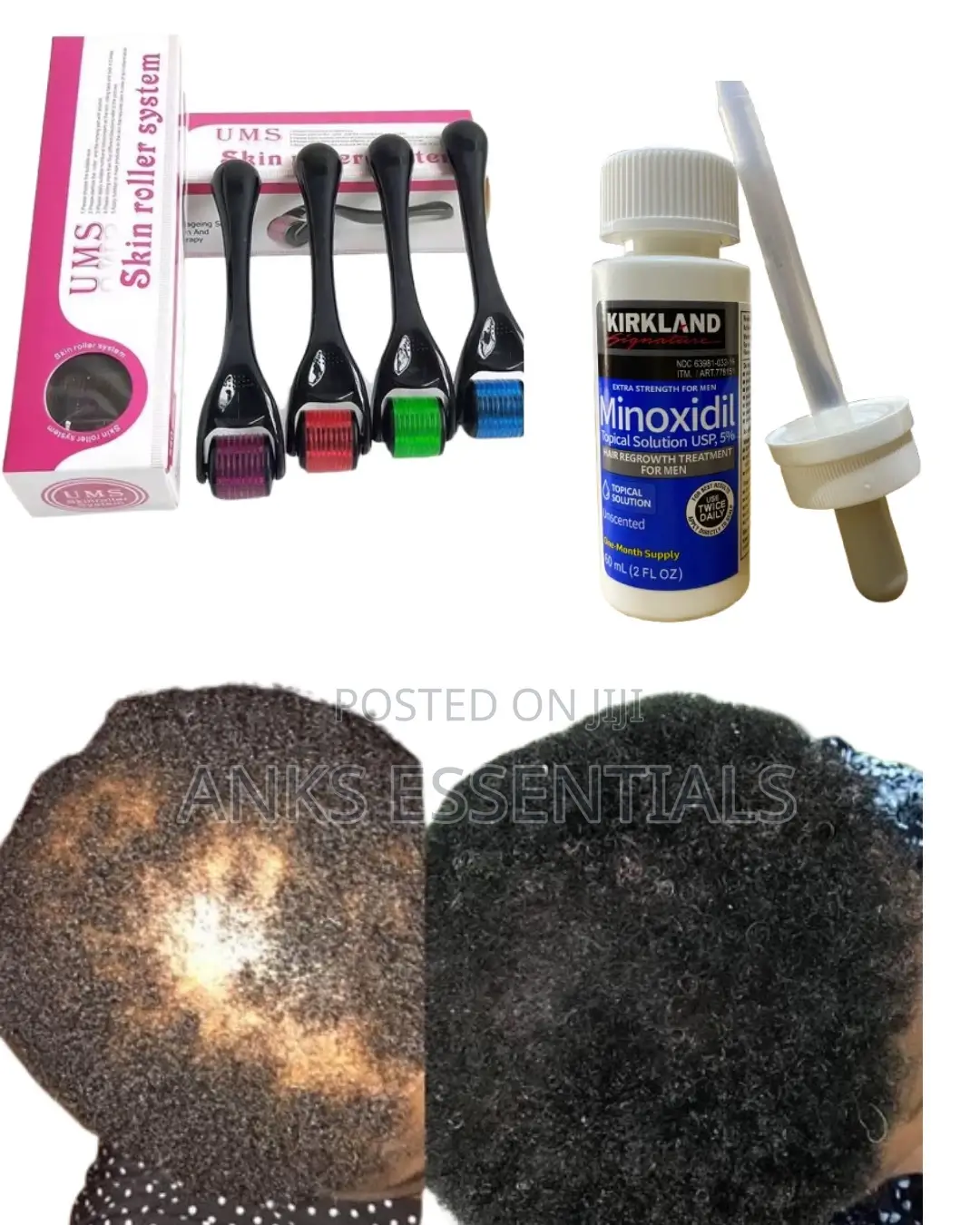Kirkland Hair Growth Kit With Derma Roller – Fast Results