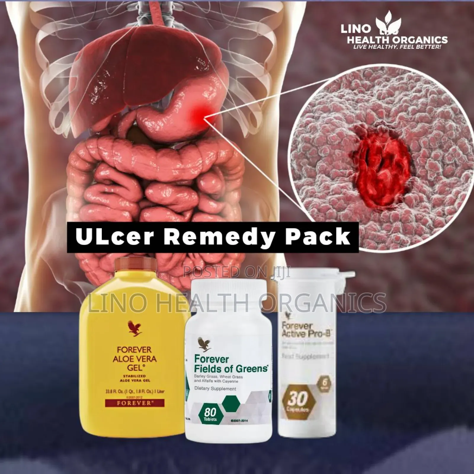 Ulcer Remedy Pack | Stomach Ulcer Natural Solution