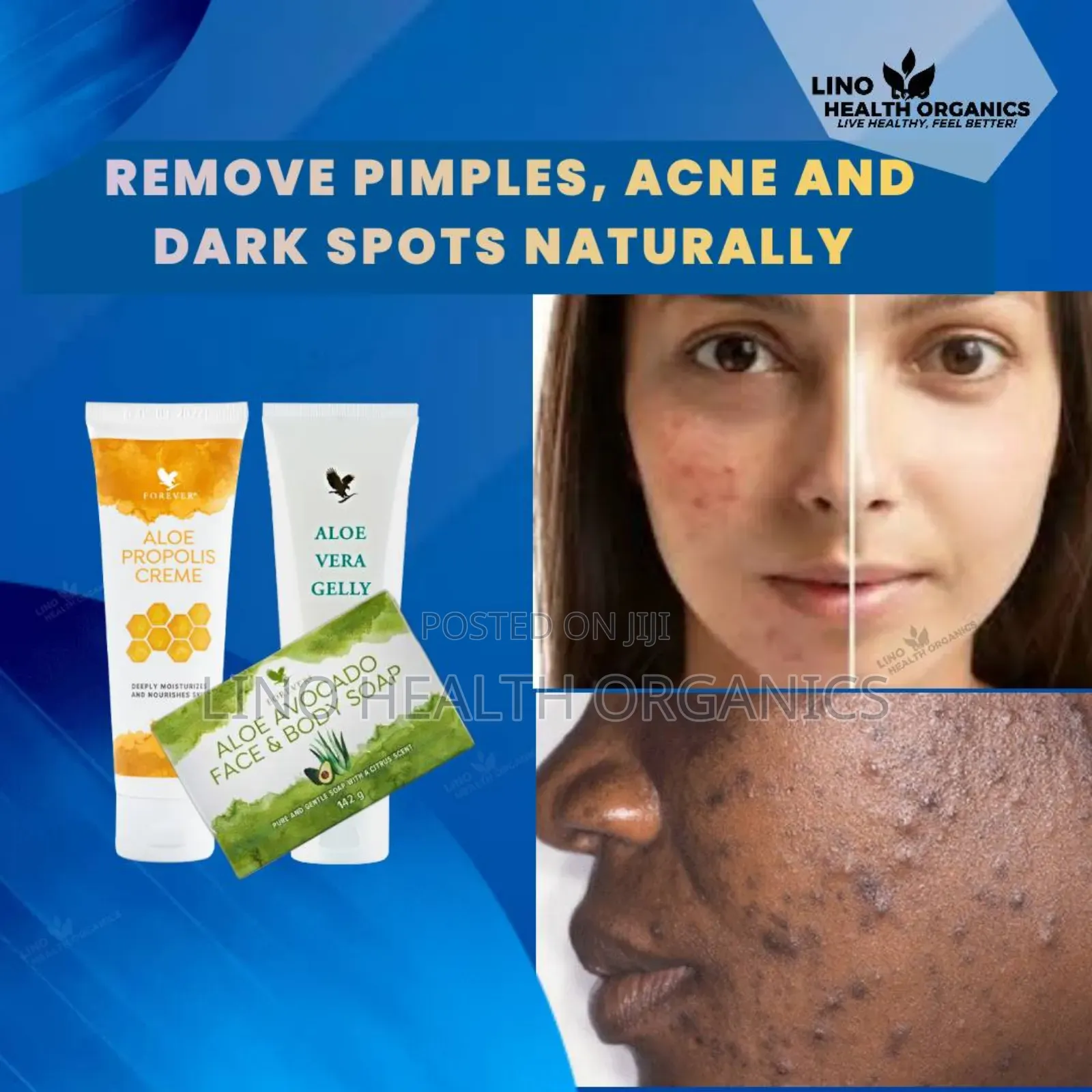 Pimples, Acne and Dark Spots Removal Pak