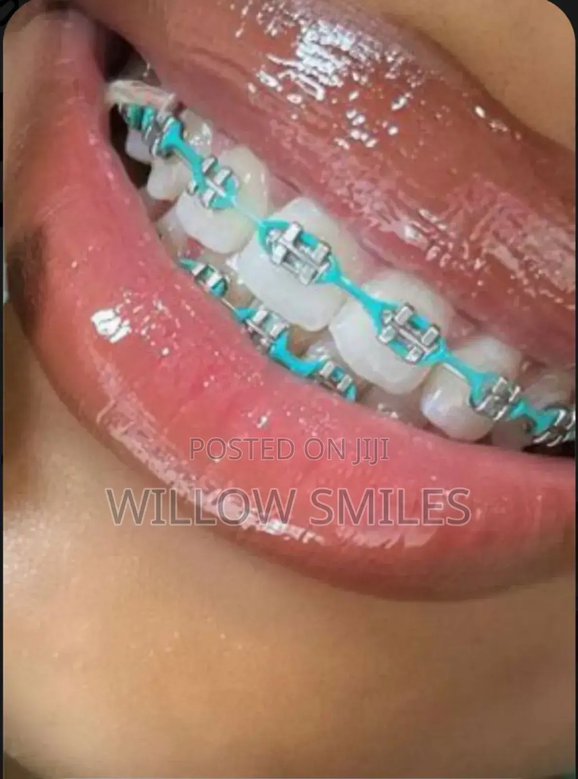 Removable Braces + Oral Care Set