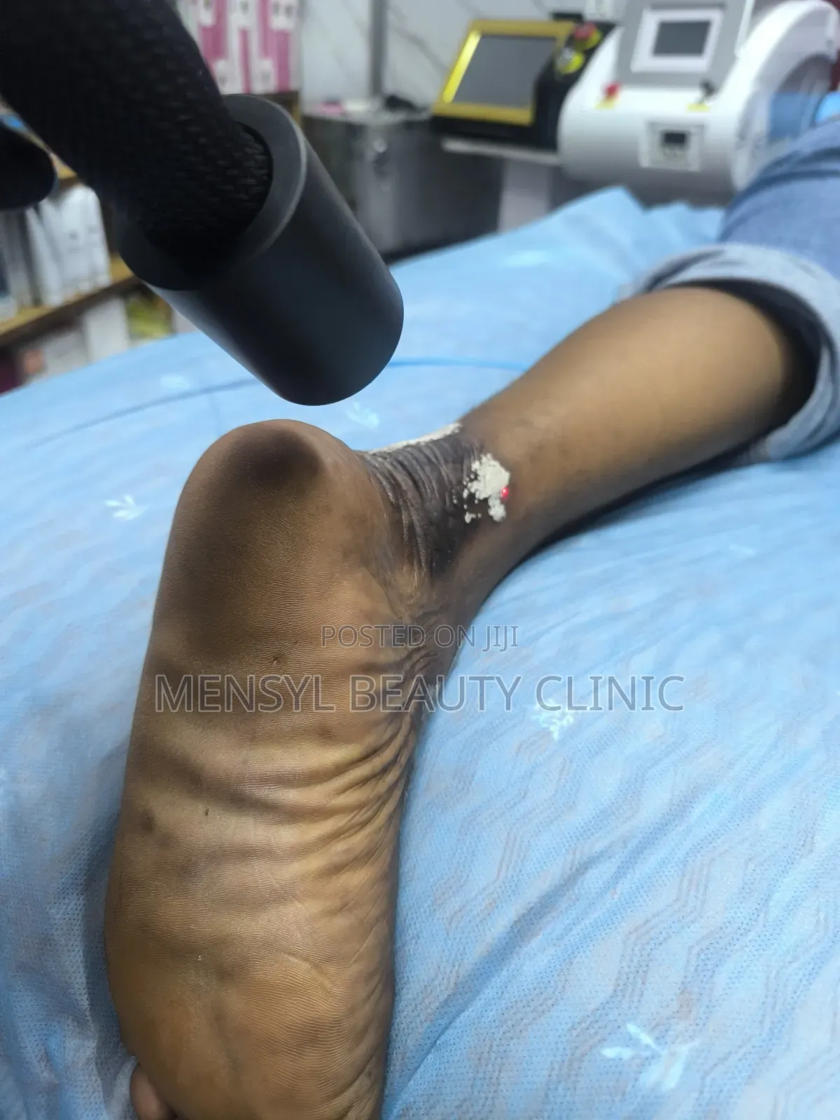 Laser Scar, Hair Removal, and Pigmentation Removal
