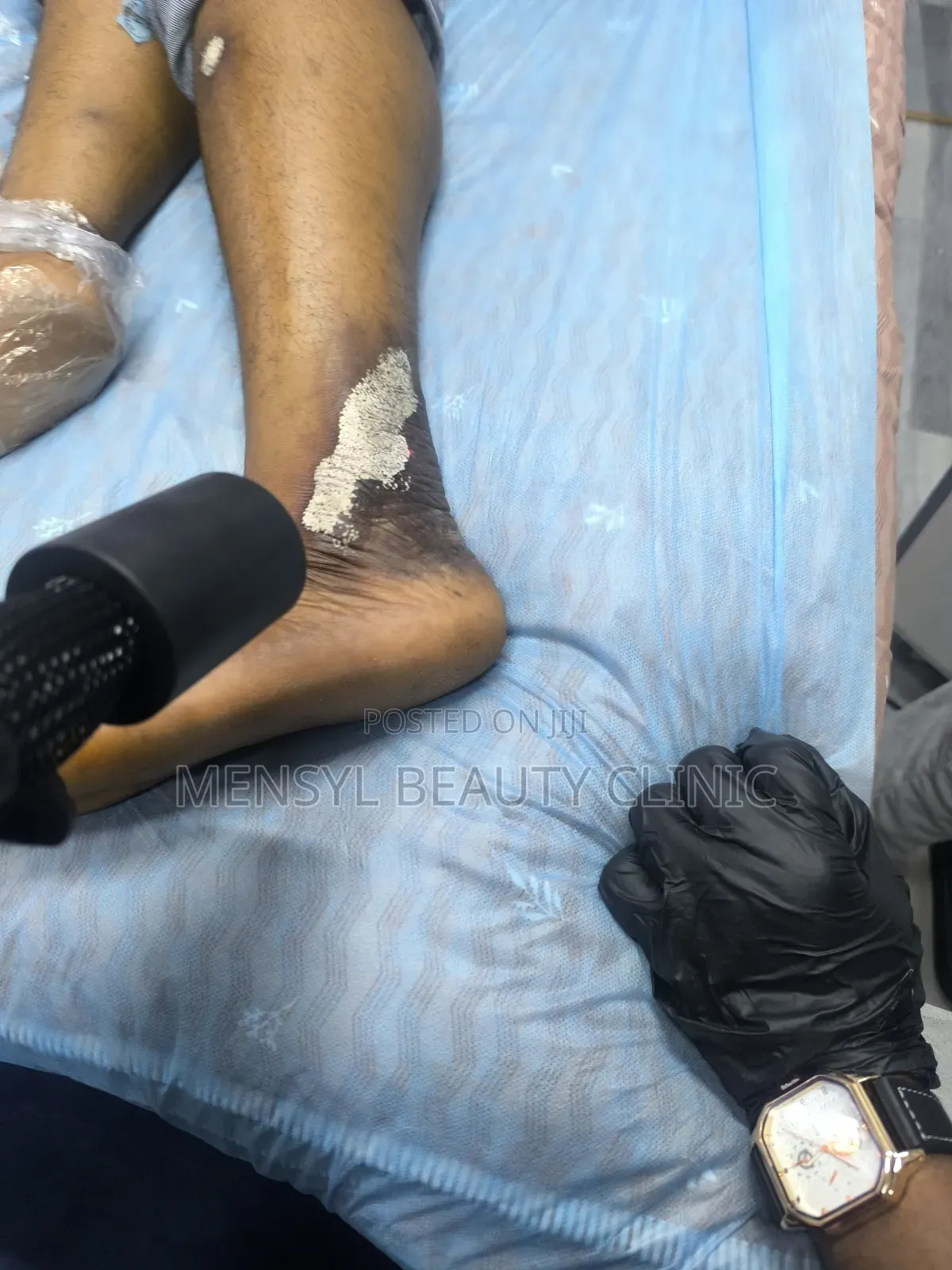 Laser Scar, Hair Removal, and Pigmentation Removal