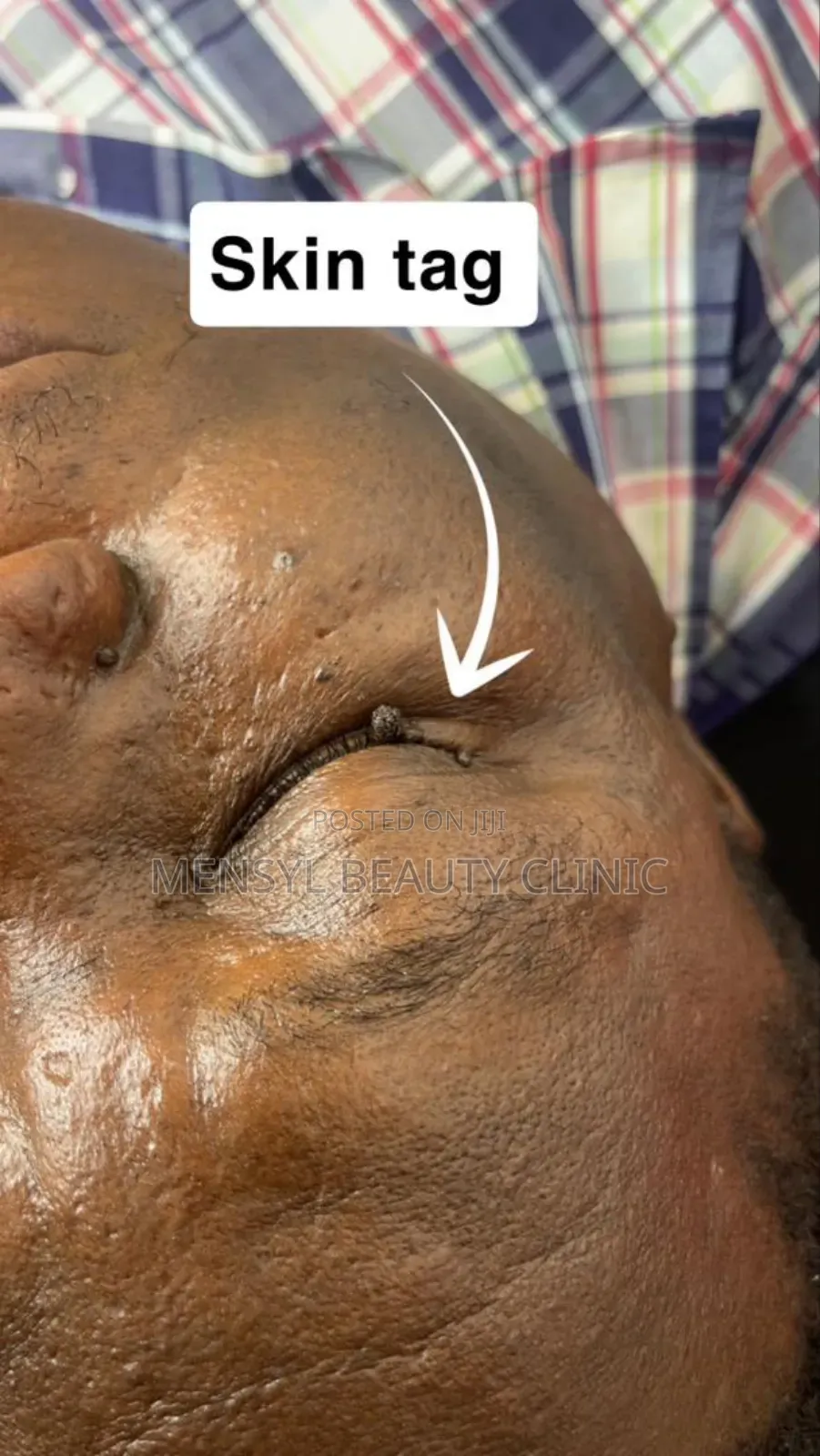 Laser Skin Tag, Warts and Moles Removal