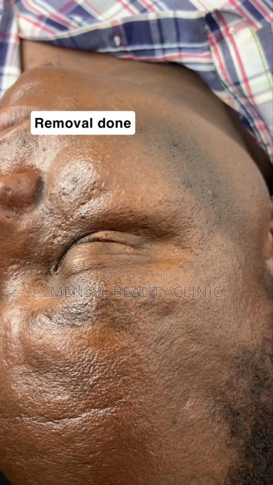 Laser Skin Tag, Warts and Moles Removal