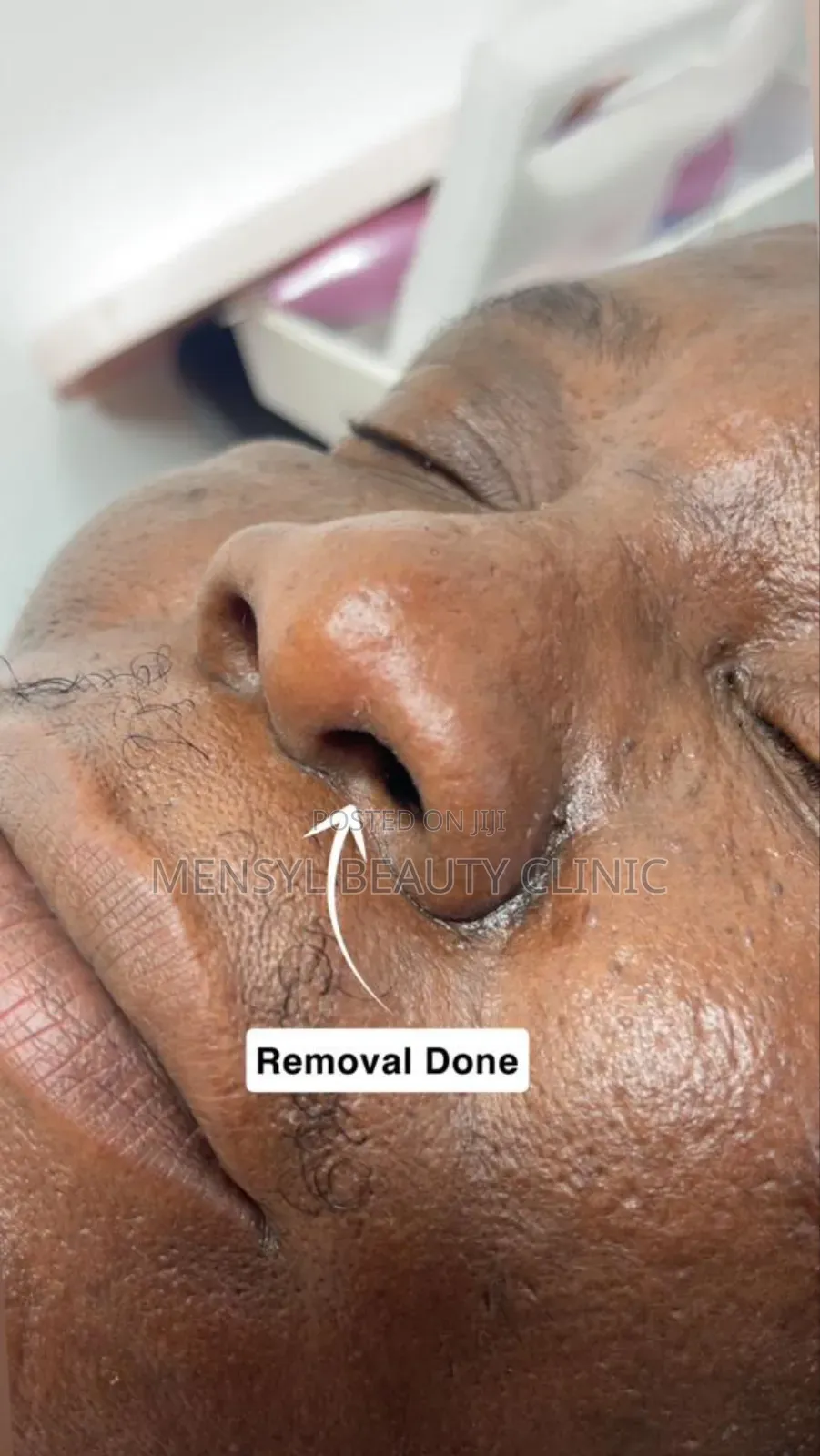 Laser Skin Tag, Warts and Moles Removal