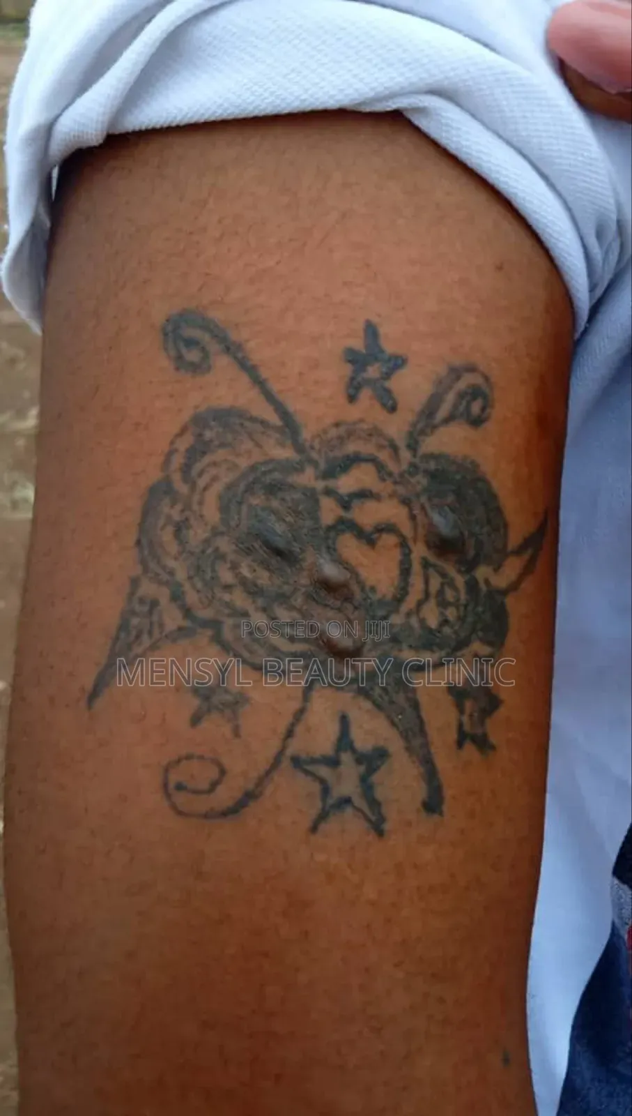 Tattoo Removal