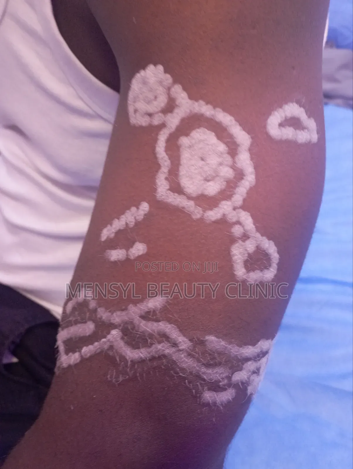 Tattoo Removal