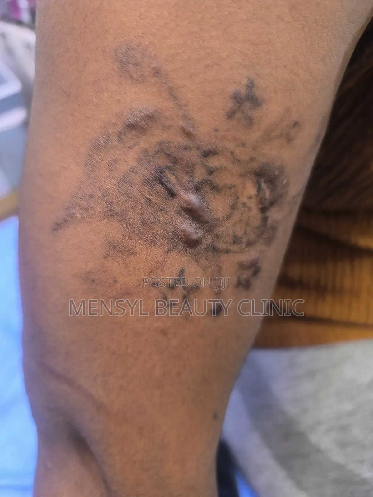 Tattoo Removal