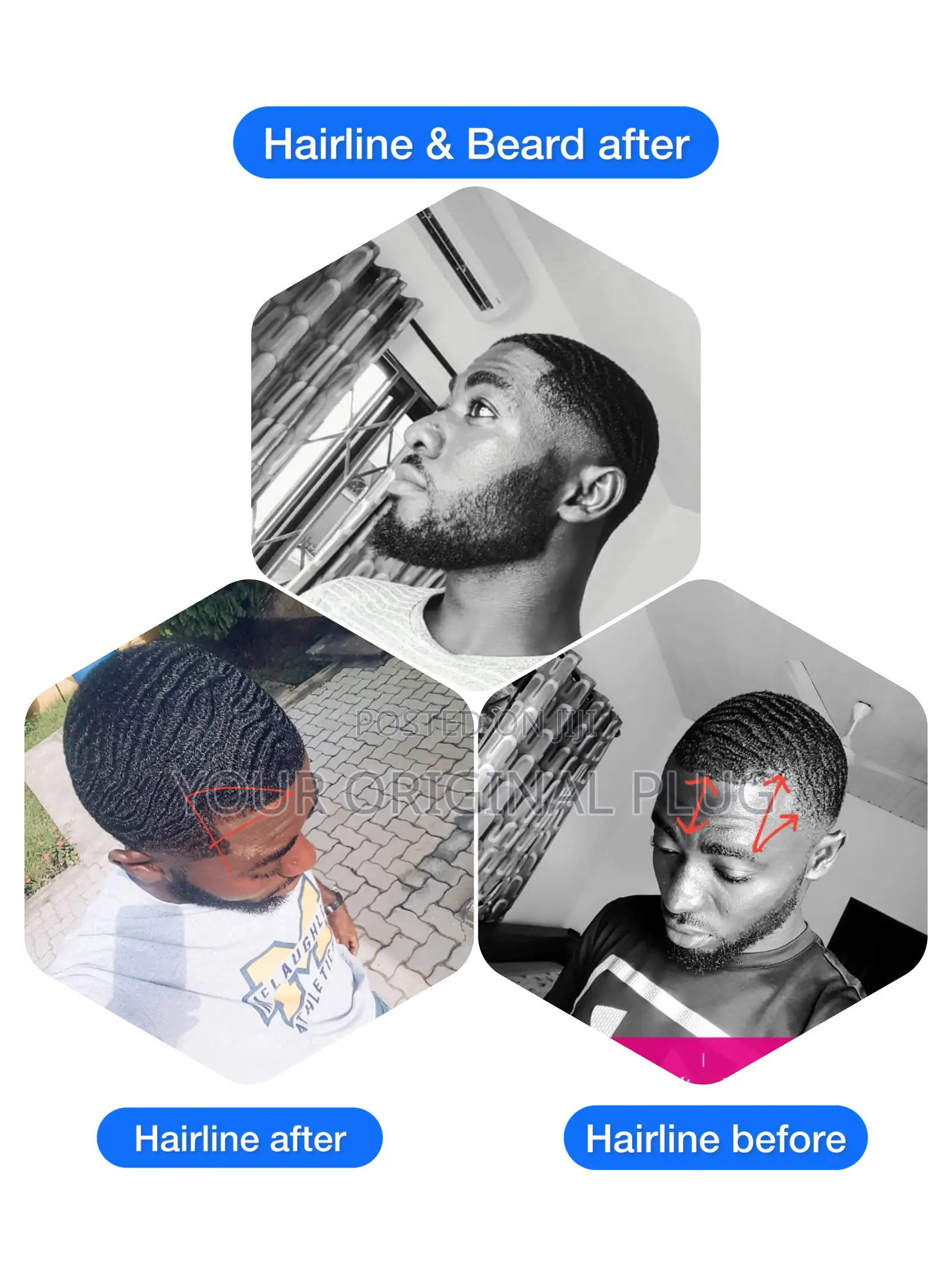 Stronger Beard,Fuller Hair—Kirkland Minoxidil + Derma Roller