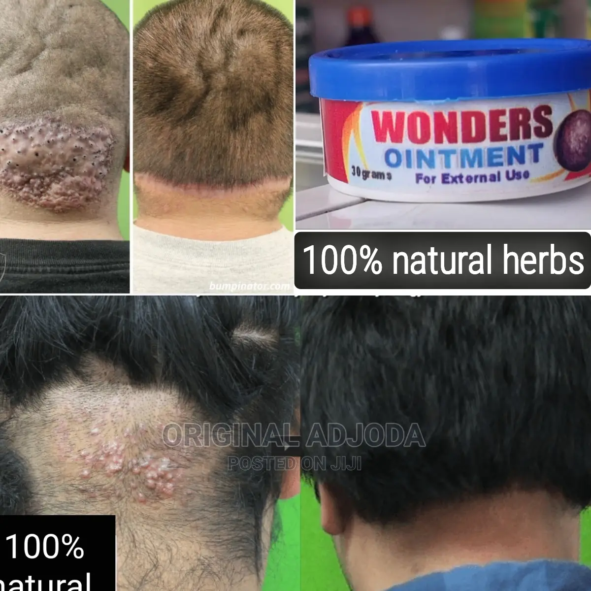 Wonders Ointment /Stubborn Razor Bumps