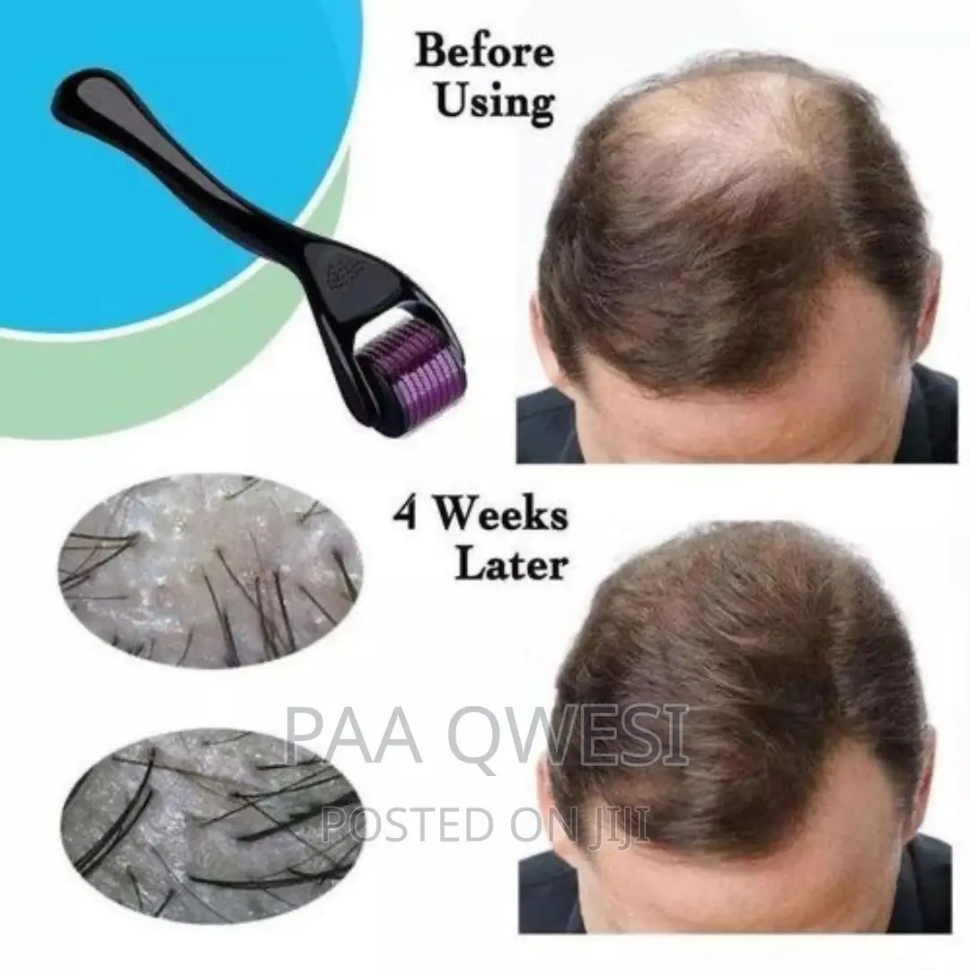 Derma Roller ( 1.5 Mm ) for Hair Scalp