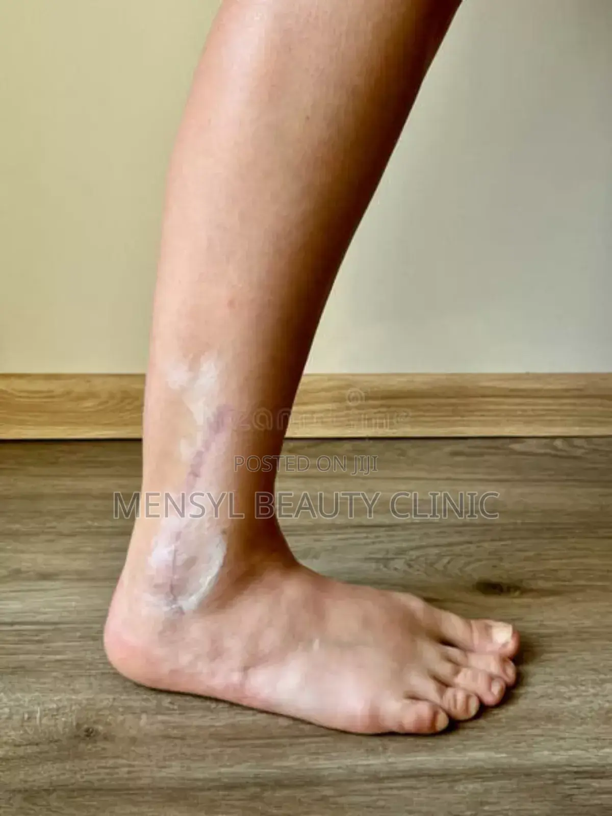 Silicone Scar Gel for All Type of Scar Including Keloid