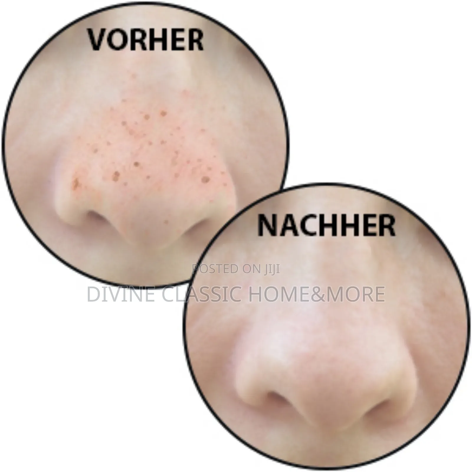 Proficare Black Head Remover