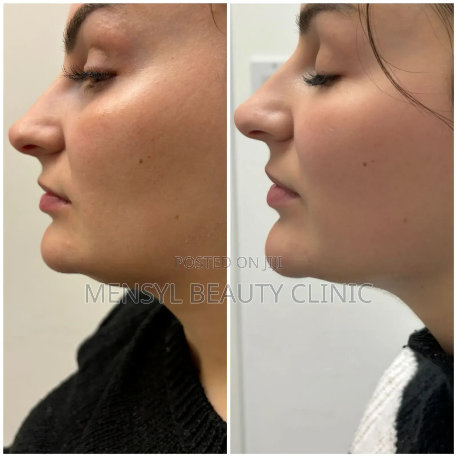 Korea Venus Slim 6d Fat Dissolving Injection for Face