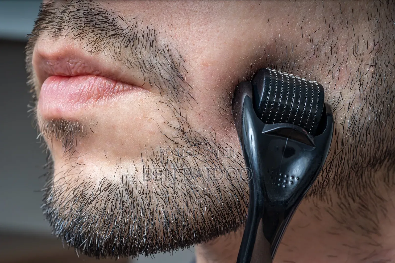Derma Roller for Hair and Beard Growth (Guaranteed Results)
