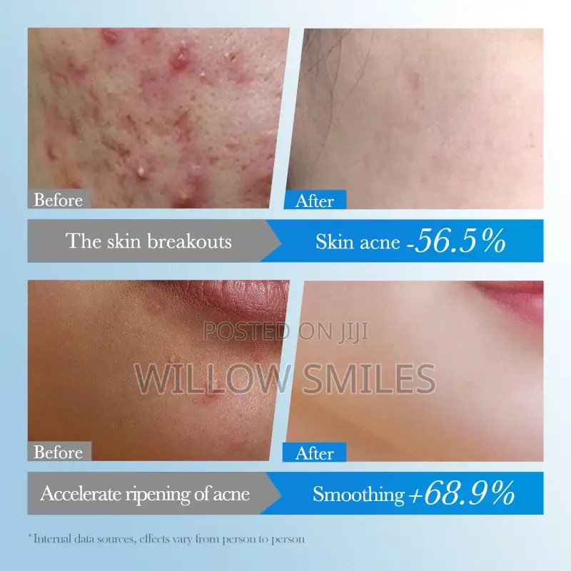 Pimple / Acne Patches (75 Patches)