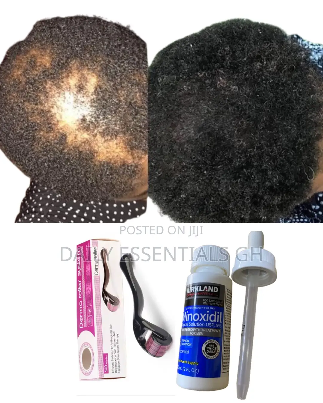 Kirkland Hair Regrowth Oil + Derma Roller for Thicker Hair