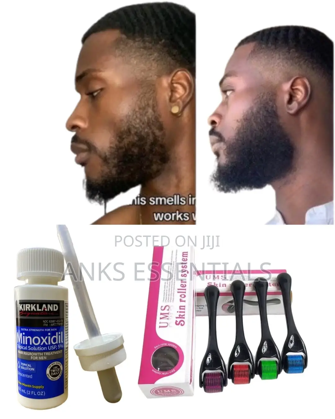 Kirkland Minoxidil + Derma Roller – Complete Hair Regrowth Package