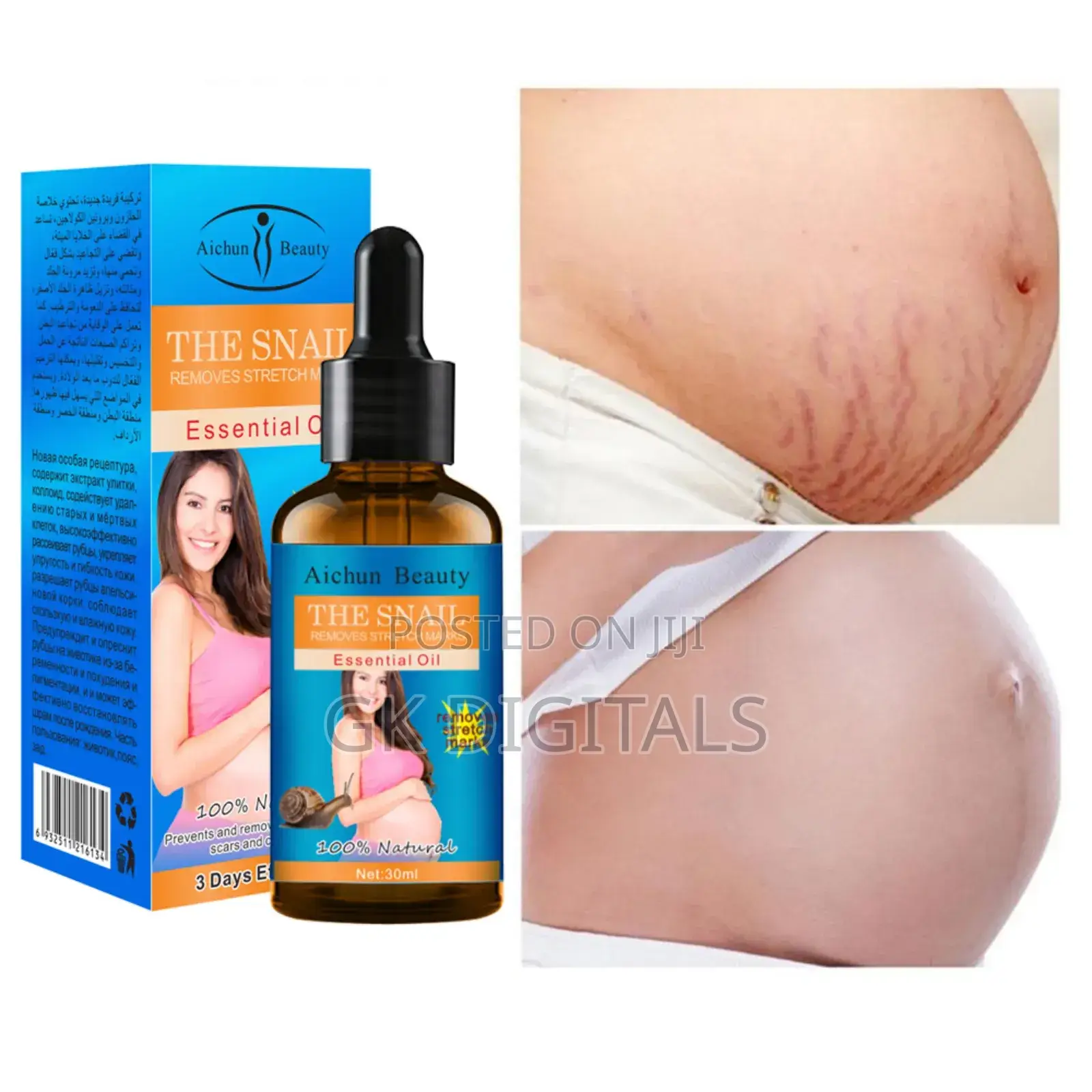 Stretch Marks Removal in a Few Week
