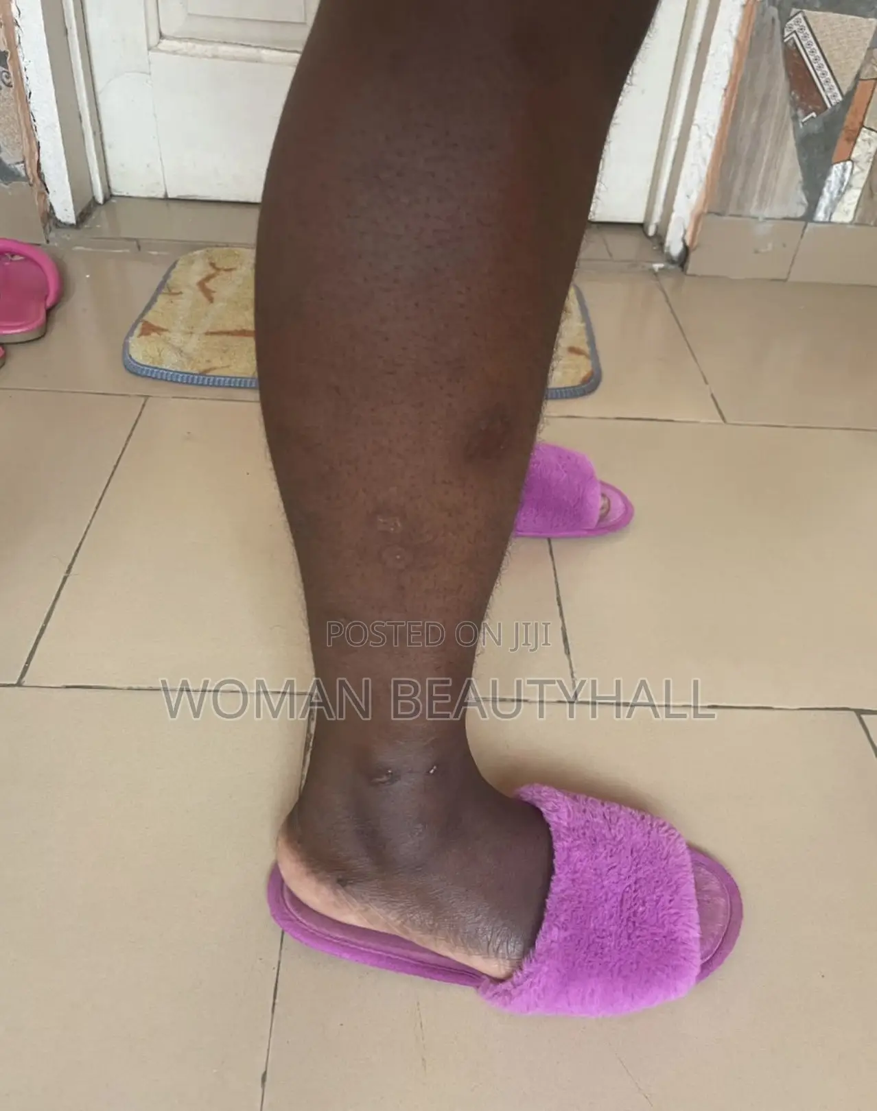 Advance Laser Scar Treatment