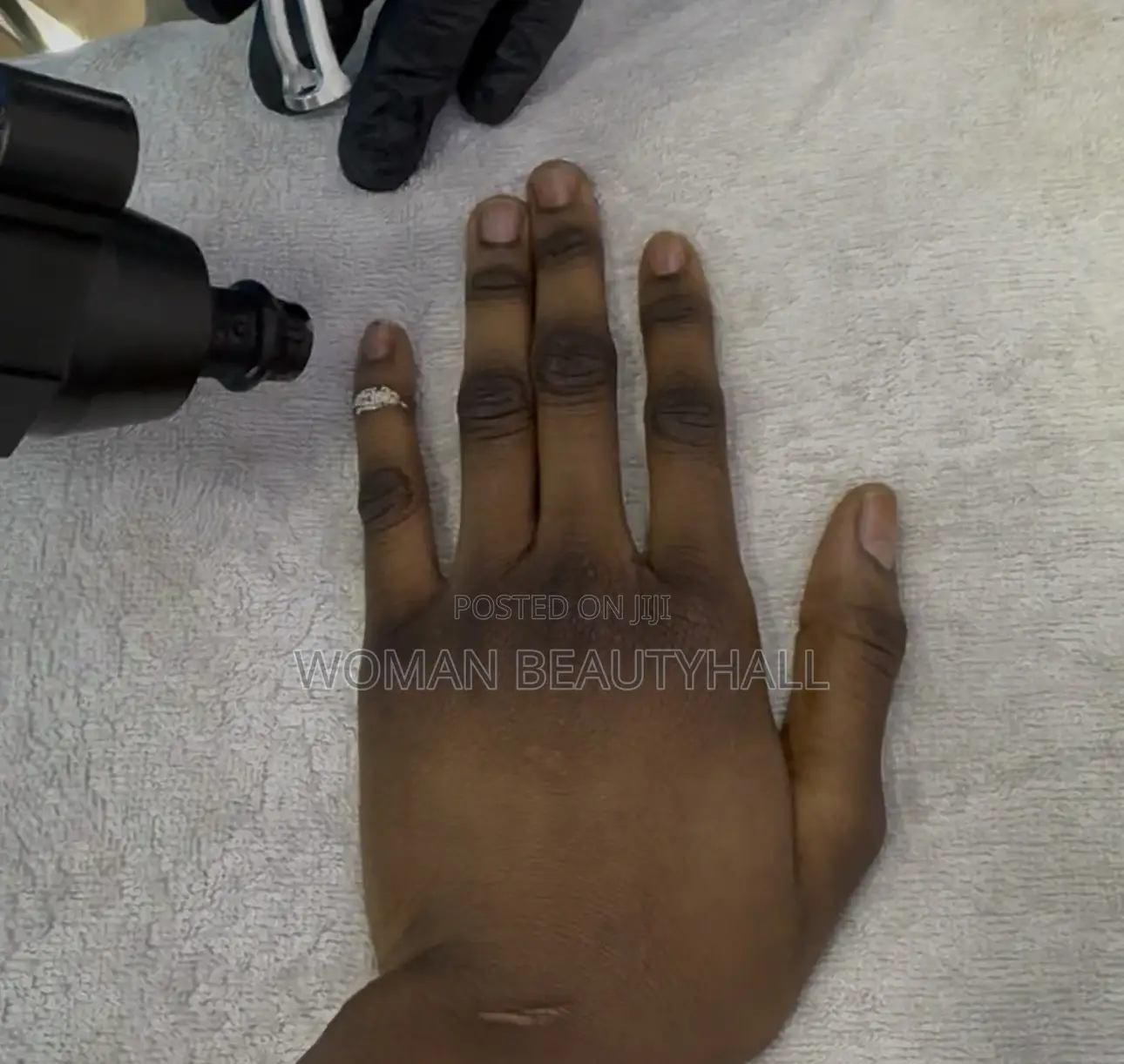 Dark Knuckles Laser Treatment