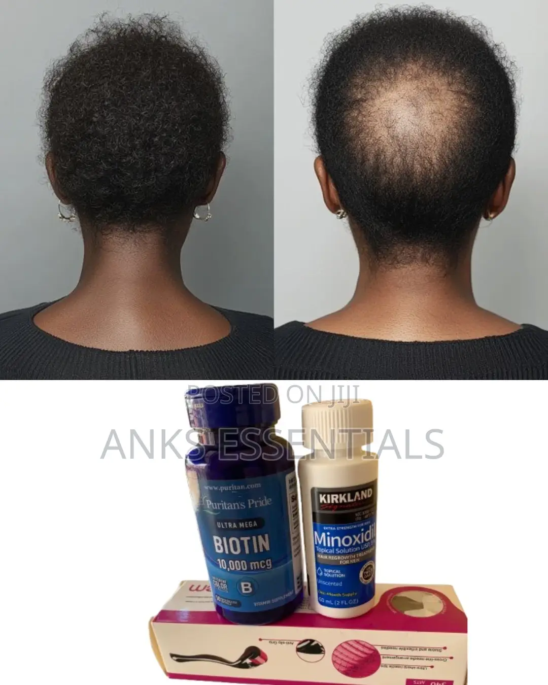 Original Kirkland Biotin Combo – Hair Growth Support