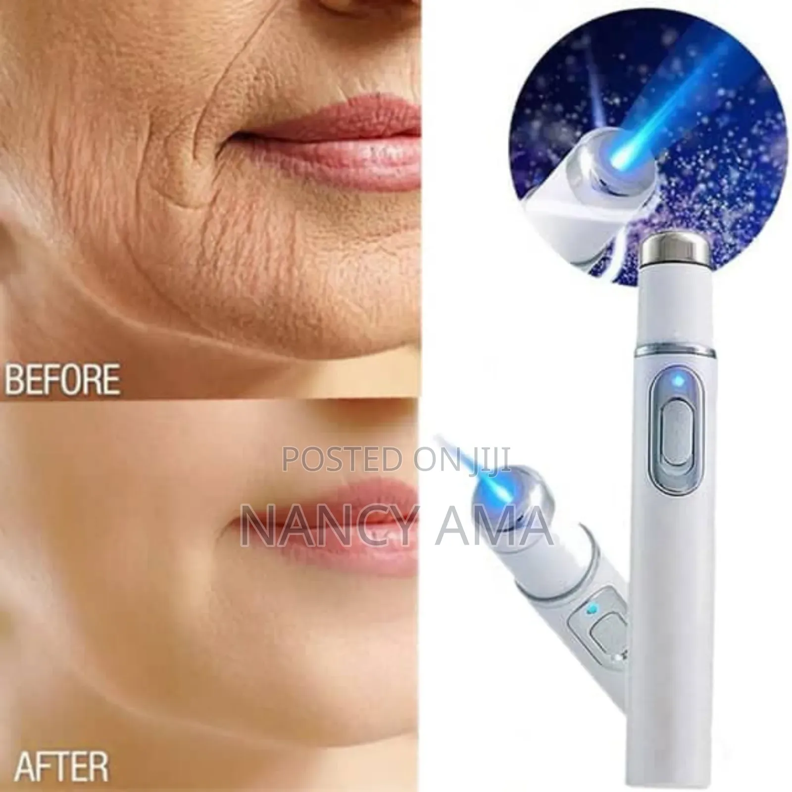 Laser Treatment Therapy Pen
