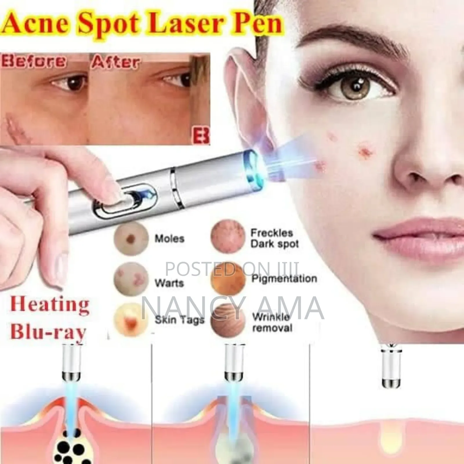 Laser Treatment Therapy Pen