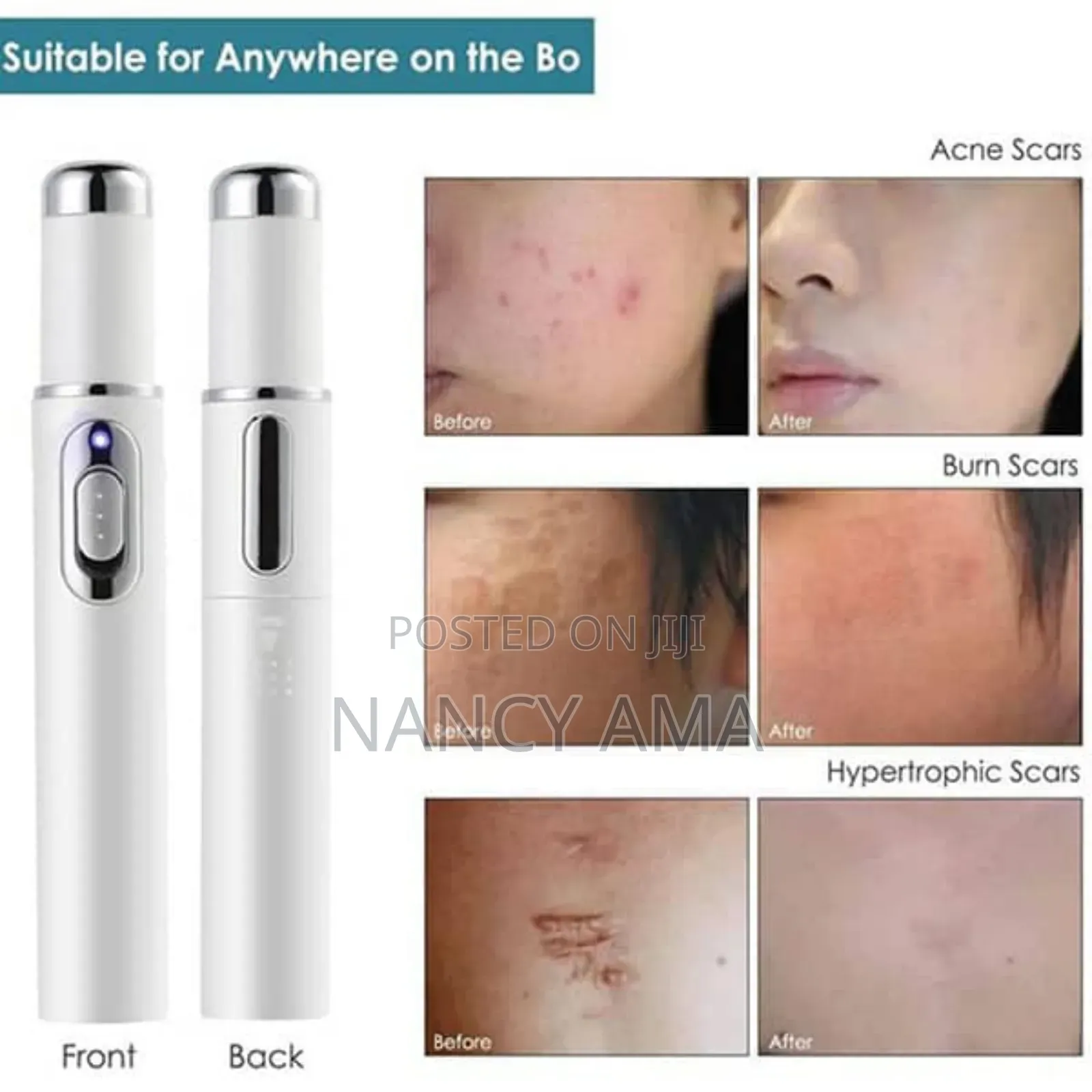 Laser Treatment Therapy Pen